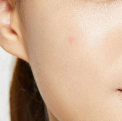 ACNE PIMPLE MASTER PATCH [24pcs]